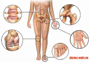 Reumatoid artritisz – Wikipédia